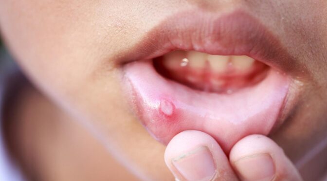 Cara Cepat Menghilangkan Sariawan, Panduan Lengkap dan Efektif