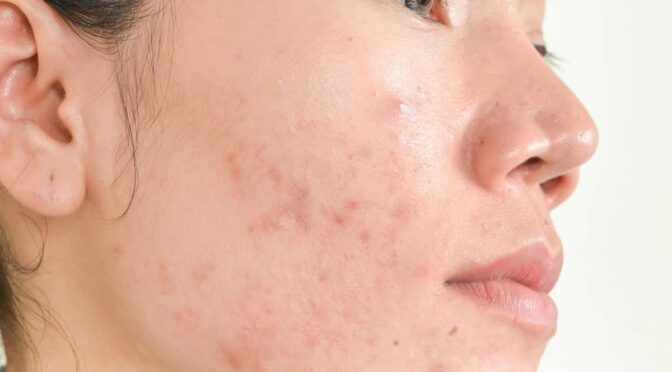 Rahasia Kulit Mulus, Ini Cara Ampuh Menghilangkan Jerawat Merah di Pipi