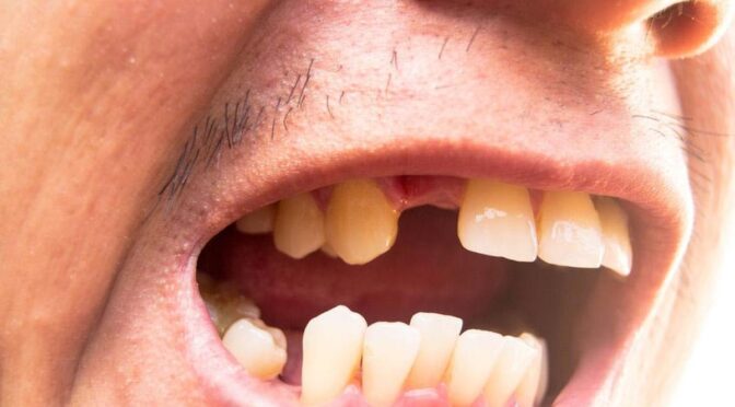 Mimpi Gigi Rontok Semua? Ini Arti dan Makna Tersembunyinya